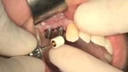 Tired of Your Flaky Teeth? Dental Surgeons India Can Help Straighten Them Out!